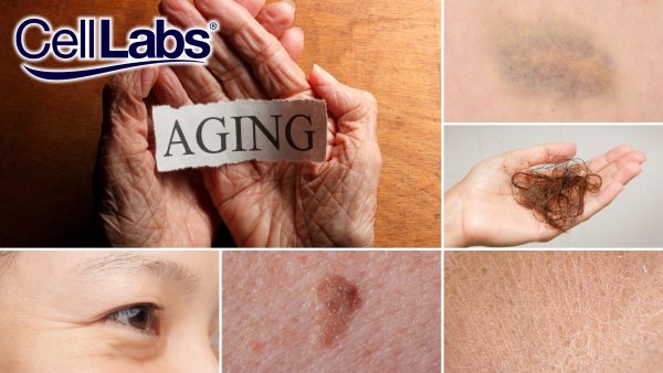 A collage on signs of aging such as wrinkles, bruising, age spots, dry skin, and hair loss.